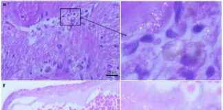 Rising Microplastic Accumulation in Human Brain Tissue: Study rising-microplastic-accumulation-in-human-brain-tissue-study