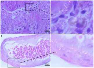 Rising Microplastic Accumulation in Human Brain Tissue: Study rising-microplastic-accumulation-in-human-brain-tissue-study